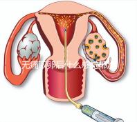 無痛取卵后什么感覺都沒有異常是謠言!只會(huì)出現(xiàn)一部分...