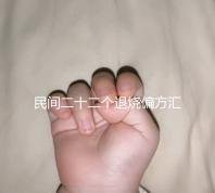 民間二十二個(gè)退燒偏方匯總，生雞蛋清、生姜放腳底還有…