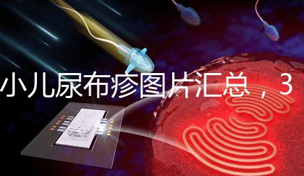 小兒尿布疹圖片匯總，3種類型癥狀大不一樣