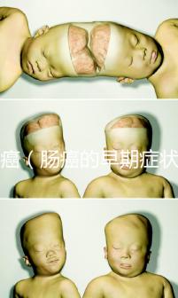 腸癌(腸癌的早期癥狀有哪些)