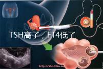 TSH高了，FT4低了，需要補碘嗎？